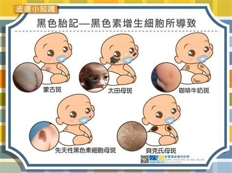 黑色胎記雷射